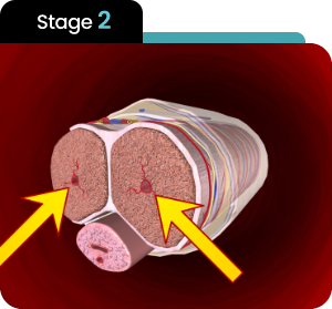Erection step 2