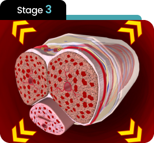 Erection step 3